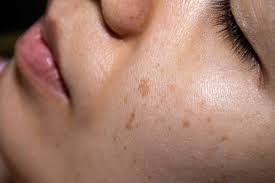 The micropen® elite is the latest innovation in medical aesthetics and one of few health canada approved devices. Mernov Spa