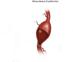 Aneurisma — aneurisma, pulsadergeschwulst, ist eine an einer arterie (s. Pin On Aneurisma Tipos Sintomas Tratamiento