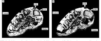 As the fiber bundles extend distally, they become grouped into four bellies. Extensor Hallucis Capsularis Frequency And Identification On Mri Semantic Scholar