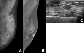 For women age 40 to 49: Screening Mammography For Second Breast Cancers In Women With History Of Early Stage Breast Cancer Factors And Causes Associated With Non Detection Bmc Medical Imaging Full Text