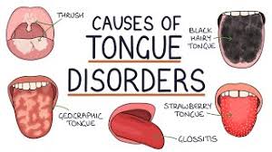 Image result for black tongue symptoms