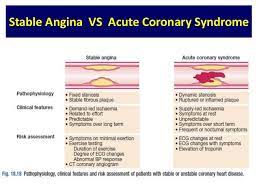 Stable Angina
