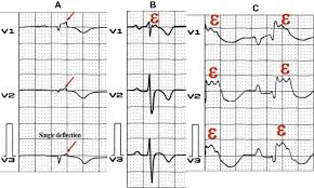 Image result for Epsilon Wave