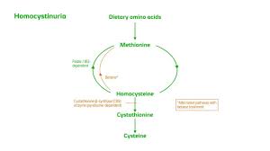Image result for Homocystinuria
