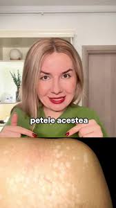 Infecția cu pitiriazis versicolor. Cum se manifestă și cum se tratează  TikTok