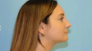 Berlet Plastic Surgery New York| Bookings Closing Soon