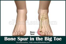 Pain is the most common symptom and is often initially treated with medications. Bone Spur In The Big Toe Symptoms Treatment Diagnosis