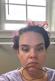 Have you ever felt embarrassed about your double-chin, the stubborn excess  fat making your neck like that of a turkey? Subcutaneous fat is often found  in the jaw and around the neck,