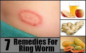 We are open, if you have a pest problem stop by for fast in and out service, we are grateful for all the first responders and the heros in our communities, who make sure we have food, gas. Top 7 Home Remedies For Ring Worm Ring Worm Remedies Home Remedies For Ringworm Ring Worm Treatment