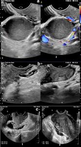 In endometriosis, cells that are similar to the inner lining of the uterus grow outside of the uterus (see image below). Relationship Between The Severity Of Endometriosis Symptoms Dyspareunia Dysmenorrhea And Chronic Pelvic Pain And The Spread Of The Disease On Ultrasound Bmc Research Notes Full Text