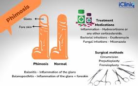 Image result for penis mycosis symptoms