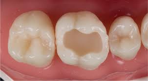 Image result for Occlusal