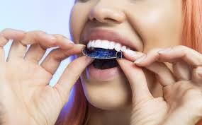 I haven't worn my retainer in over a year and my teeth are still in the same position as when i first got my braces taken off. Permanent Versus Removable Retainers Which Is The Best Choice Millennium Park Orthodontics Orthodontics