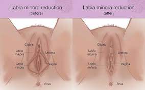 Would a ingrown hair hurt in the shower if water hits in the vaginal area? Female Rejuvenation Canmore Medispa