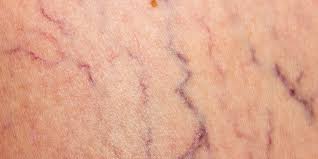 If You Ve Ever Considered Taking Vitamin K For Spider Veins You Need To Read This Prevention