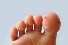 Image result for verruca