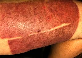 Split Thickness Skin Grafts Myempd Com