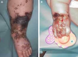 Dysfunction of endothelial protein c activation in severe meningococcal sepsis. Pneumococcal Septicaemia With Purpura Fulminans In An 11 Month Old Child Journal Of Plastic Reconstructive Aesthetic Surgery