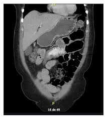 Image result for Adynamic Ileus