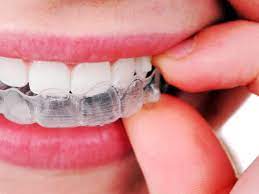 Ordinale subito con uno sconto del 10% extra: Mascherine Per Denti Storti Invisalign Come Funzionano E Quanto Costano La Salute In Bocca