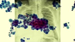 Early symptoms of mesothelioma are more often caused by other things, so at first people may ignore them or mistake them for common, minor ailments. Handling Your First Talk With A Newly Diagnosed Mesothelioma Patient Daily Nurse