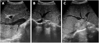 Imaging And Interventions In Budd Chiari Syndrome
