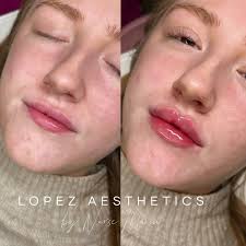 Cheek and Lip Filler