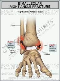 This Trial Exhibit Depicts A Bimalleolar Right Ankle Fracture Showing Fractures Of Both The Medial Malleolus And Lateral Ankle Fracture Ankle Anatomy Fracture