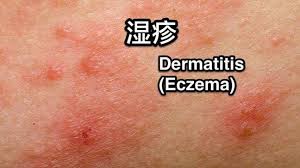 不论婴幼儿湿疹(eczema)还是成人湿疹，恼人的是容易反复发作，目前还没有任何一种药物可以根治湿疹。  临床医学用的药膏大都是激素类，也只是减轻炎症，缓解抓挠的强烈欲望！  在临床医学上，西医开的药物以止痒抗过敏为主。如果使用激素类的药物可能会导致病情加重，还会 ...