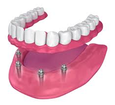Image result for dentures