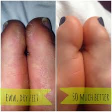 If you have athlete's foot you can soak your feet in vinegar for 3 minutes before taking a. Vinegar Foot Soak Foot Soak Vinegar Homemade Foot Soaks Apple Cider Vinegar Face Mask