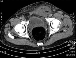 It is a multifactorial disease process, with etiology encompassing genetic factors, environmental exposures (including diet), and inflammatory conditions of the digestive tract. Perforated Sigmoid Colon Cancer Presenting As An Incarcerated Inguinal Hernia A Case Report Sciencedirect