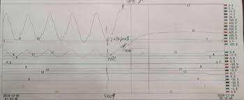 Trend Chart Of Low Pressure Shaft Seal Steam Inlet