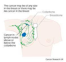 Use the menu to see other pages.staging is a way of describing the how extensive the breast cancer is, including the size of the. Stage 3 Breast Cancer Cancer Research Uk