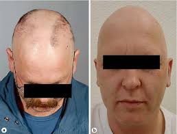 Nikolas hedberg discusses all the possible causes of alopecia areata and alopecia universalis. Alopecia Areata Universalis Elicited During Treatment With Adalimumab Semantic Scholar
