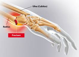 Fracture Du Poignet Hopital Prive Drome Ardeche