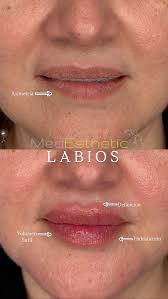 El aumento de labios con ácido hialuronico te permite recuperar el volumen  perdido con el pasar del tiempo, mejorar asimetrías, dar hidratación y  mejorar el contorno del labio., Citas vía Dm.