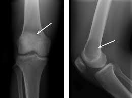 If you do not receive the correct treatment it's important not to eat or drink anything if you think you've broken a bone, as you may need a general anaesthetic to allow doctors to realign it. Giant Cell Tumor Of Bone Orthoinfo Aaos