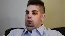 Mitch Hunter Describes His Face Transplant Video - Brigham and ...