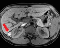 Thoracic endometriosis occurs very rarely, only in 2% from those lenshin a.v., bystritskaya t.s., il'in a.v., kraynov s.a. Atypical Sites Of Deeply Infiltrative Endometriosis Clinical Characteristics And Imaging Findings Radiographics