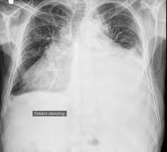 A pleural effusion is an abnormal collection of fluid in the pleural space resulting from excess fluid production or decreased absorption or both. Pleural Effusion Causes Types Symptoms Diagnosis And Treatment