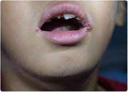 Tabiat sebegitu mungkin akan memberikan kelembapan yang. Angular Cheilitis Luka Di Tepi Bibir