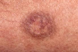 Lesion In Fixed Drug Eruption Stock Image C050 9953 Science Photo Library