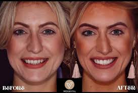 VICI Dental Gallery: Patient Smile Transformations In Leeds