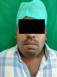 Case Report: Ludwig's angina