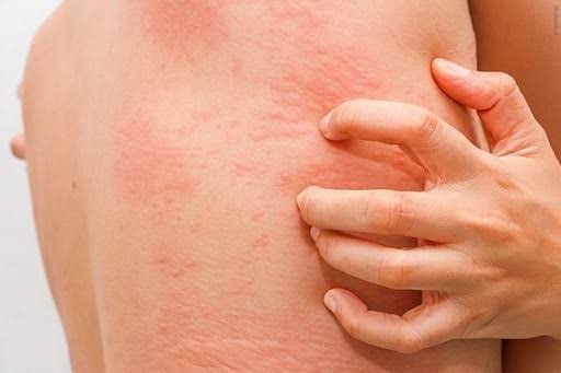 Nguyên nhân gây ngứa da toàn thân? Cách điều trị hiệu quả