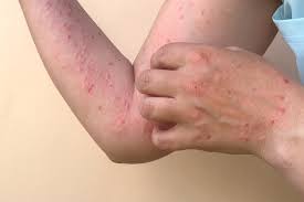 Skin Infection Treatment