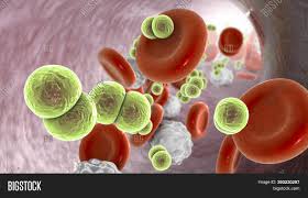 Septicemia caused by this pathogen is also referred to as meningococcemia. Meningococcemia Image Photo Free Trial Bigstock