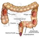 Bloody Or Tarry Stools: Causes Treatment