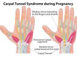 How To Treat Carpal Tunnel Syndrome During Pregnancy